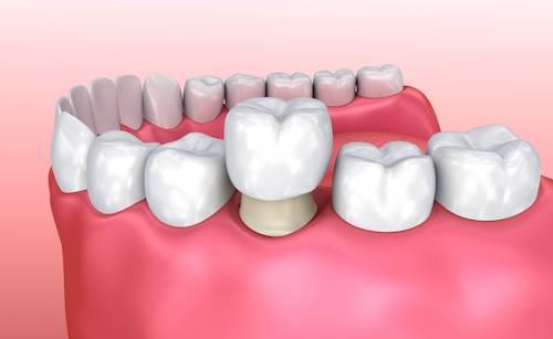 teeth illustration in Casino, NSW 2470